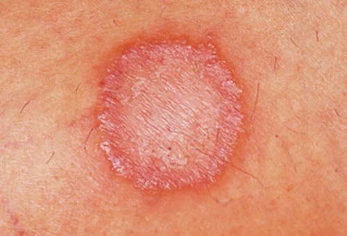 nhóm bệnh da liễu