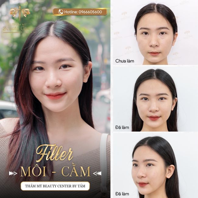 Beauty Center By Tấm là trung tâm thẩm mỹ có hơn 10 năm kinh nghiệm làm đẹp bằng Filler | Nguồn: Beauty Center By Tấm