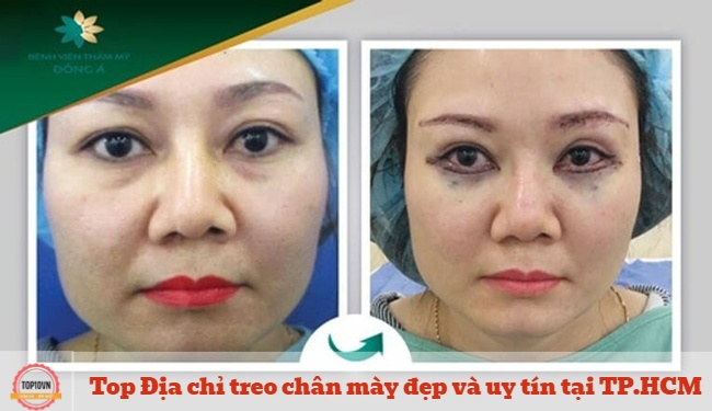 Khách hàng treo chân mày tại Bệnh viện Đông Á cũng có thể cấy mỡ hoặc phun xăm để nâng cao vẻ đẹp và sự cân đối cho đôi chân mày | Nguồn: Bệnh viện Đông Á