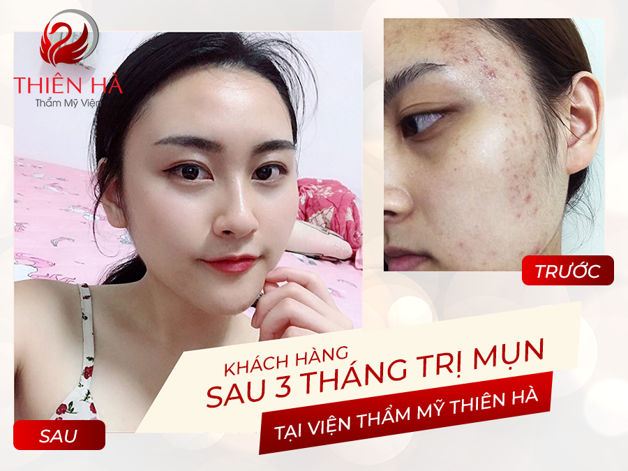 địa chỉ trị mụn uy tín Hà Nội - Viện thẩm mỹ Thiên Hà