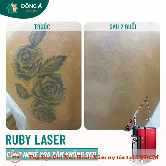 Thẩm mỹ viện Đông Á sử dụng công nghệ Ruby Laser để phá vỡ mực xăm thành các hạt siêu nhỏ bằng cách sử dụng bước sóng ngắn | Nguồn: Thẩm mỹ viện Đông Á