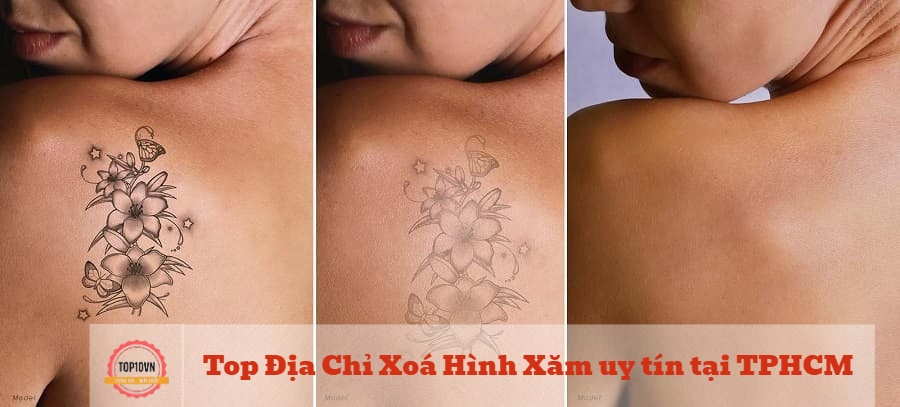 Chọn loại mực xăm có thể loại bỏ được mà không gây tổn thương cho vùng da xung quanh và không tạo sẹo | Nguồn: Shapeline