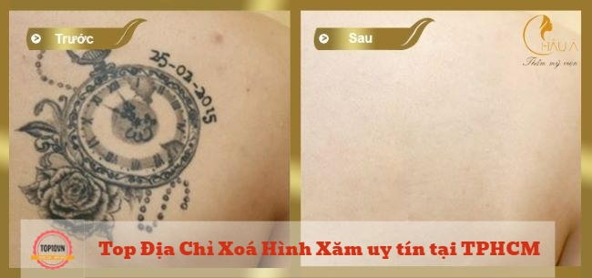 Thẩm mỹ viện Châu Á có thể sử dụng công nghệ Laser Toning Plus để xóa hình xăm trên da | Nguồn: Thẩm mỹ viện Châu Á