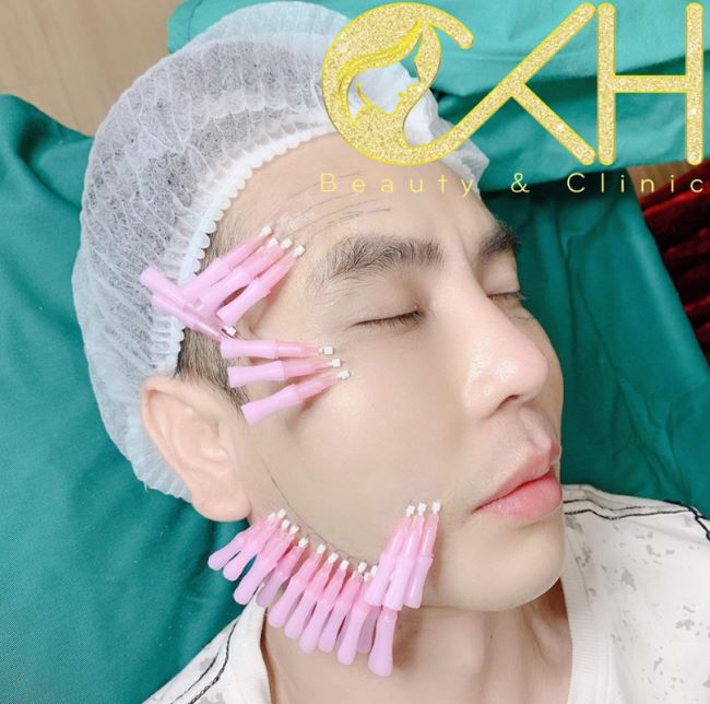 CKH Beauty & Clinic (Chu Khả Hiếu) đủ tự tin về kinh nghiệm thực tế cũng như kiến ​​thức để thực hiện căng chỉ collagen hiệu quả, an toàn nhất | Nguồn: CKH Beauty & Clinic (Chu Khả Hiếu) 