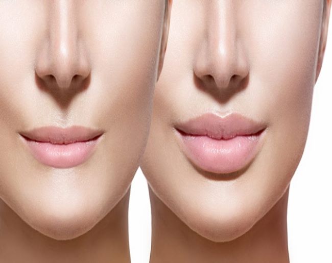 Pensilia là địa chỉ tiêm filler môi tại TPHCM chất lượng nhất | Nguồn: Pensilia