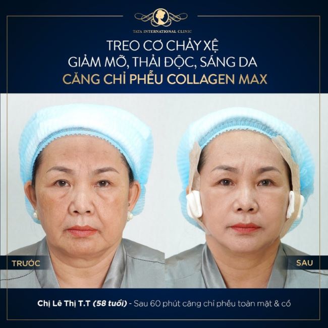 Chỉ collagen được sử dụng tại Phòng khám Đa khoa Quốc tế Tata có hàm lượng protein, HA và collagen cao, mang đến sự an toàn 100% cho cơ thể con người | Nguồn: Phòng khám Đa khoa Quốc tế Tata