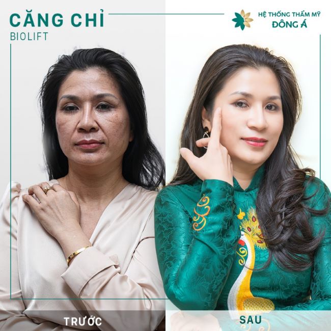 Căng da mặt bằng chỉ Collagen có thể được thực hiện thuận lợi hơn nhờ vào tay nghề thẩm mỹ cũng như trình độ chuyên môn dày dặn của các chuyên gia Đông Á | Nguồn: Thẩm mỹ viện Đông Á