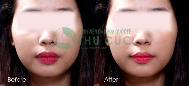 Thu Cúc thực hiện theo tiêu chí tiêm Filler của Bộ Y tế gồm các bước thực hiện khoa học và tỉ mỉ | Nguồn: Thẩm mỹ Thu Cúc Sài Gòn