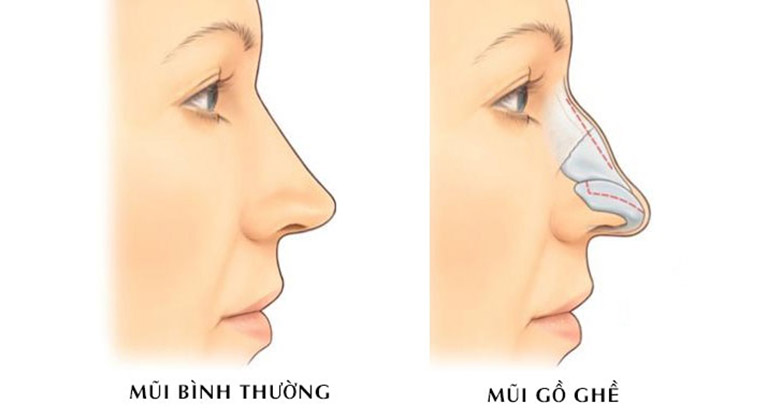 sửa mũi gồ